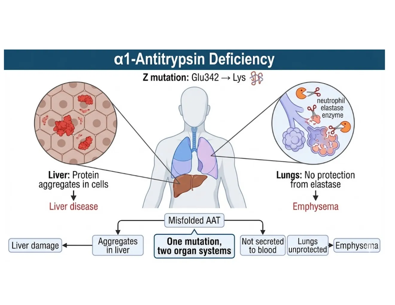 A clinical schematic of alpha-1-antitrypsin deficiency: a Glu342Lys mutation causes liver aggregation and, separately, lung emphysema.